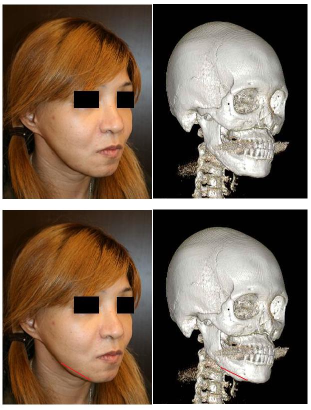 美容形成外科後遺症 ルフォー 型骨切り術 鼻中隔延長術