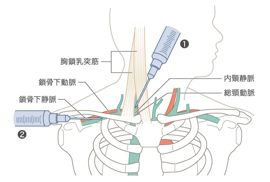 超音波ガイド下内頚静脈穿刺 ultrasound 