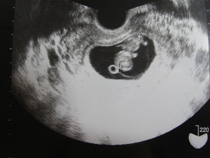嚢 いつまで 卵黄 希望が欲しくて。卵黄嚢確認、胎芽見えずで不安です