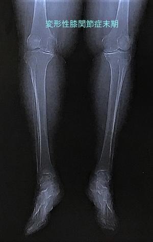 変形性膝関節症と人工膝関節置換術 - ふふふな毎日