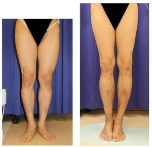 脚延長術　右下肢：ISKD＋創外固定　　左下肢：ISKD（178㎝→185.5㎝） - 美容外科医のモノローグ