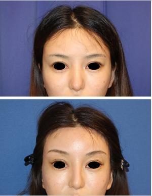 エンドタイン(endotine forehead)使用　額リフト、　こめかみリフト　鼻根縮小術　術後約3か月再診時 - 美容外科医のモノローグ