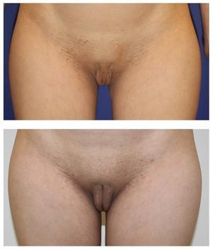 他院外陰部術後　　陰裂形成術　および　大陰唇脂肪移植術 - 美容外科医のモノローグ