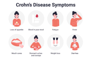 Crohn's Disease: Diagnosis, Symptoms, and Treatment of a Chronic Disease of the Bowel - 
