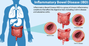 IBD (Inflammatory Bowel Disease): Types, Symptoms, and Management of Bowel Inflammation - 