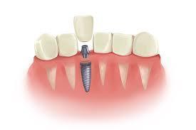 Should Dental Implants Move - 