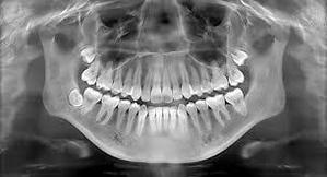 Can I Refuse Dental X Rays - 