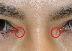 他院目頭切開術後　の凹み　に対して　剥離術+ヒアルロン酸注入による　凹み改善 - 美容外科医のモノローグ