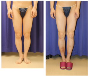プリサイス（precice )2 脚延長術　　両下腿　５ｃｍ延長後　約1年半再診時 - 美容外科医のモノローグ