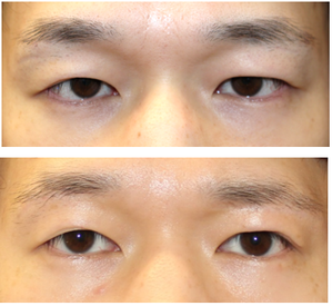 眉下切開　+　上眼窩脂肪除去　　術後約1年再診時 - 美容外科医のモノローグ