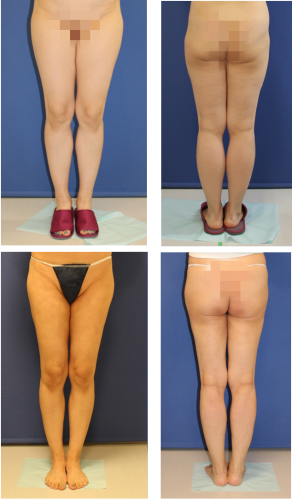 ベイザー併用　大腿全周脂肪吸引+膝周囲脂肪吸引+ふくらはぎ脂肪吸引　　+　ＮＩＣＲ（非切開式ふくらはぎスリム形成術） - 美容外科医のモノローグ