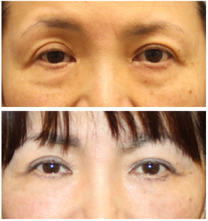 眉上切開リフト　+　上眼瞼への脂肪移植　+　目の下のたるみとり（目の下の眼窩脂肪除去+下眼瞼への脂肪移植　） - 美容外科医のモノローグ
