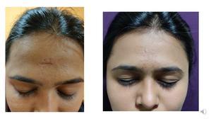 副作用に対する皮膚手術 - 