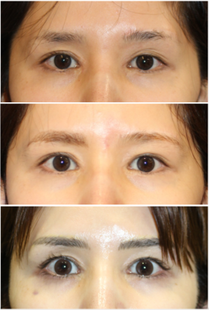 眉　移動術　　（左側の眉を中央側へ移動）　術後３年再診時 - 美容外科医のモノローグ