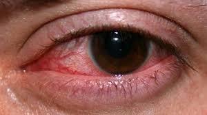  First Aid for Vinegar in the Eyes - 