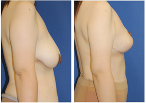 乳房縮小吊り上げ術　術後約半年再診時 - 美容外科医のモノローグ