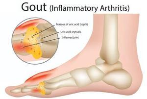 Recognize the Symptoms of Gout and Ways to Treat It - 