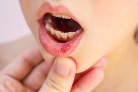 This is How to Treat Stomatitis - 