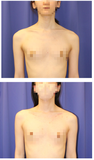 肩幅短縮（鎖骨短縮術）：プレート法　術後約半年再診時 - 美容外科医のモノローグ