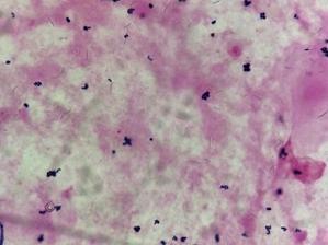グラム染色で紐状に抜けて見える菌が多数認められた場合、焦った方がいいですよ - Sakai-infections