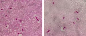 莢膜で覆われたGNRと肝膿瘍　眼内炎の評価はどうするか？ - Sakai-infections