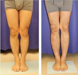 プリサイス 脚延長　術　術後約　１５か月　再診時　（左右５㎝延長） - 美容外科医のモノローグ