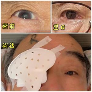 白内障手術 - ■■ Ainame60 たまたま日記 ■■