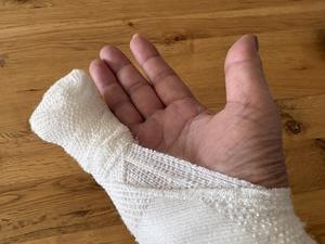 ヘバーデン結節の手術をしてきました！ - Smart chic