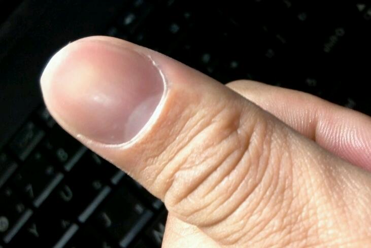 スプーン爪とは 症状と治療 ひょうそうの痛み ネイル 爪の病気 治療関係 トコマ商会