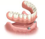 全ての歯を失った場合　_b0000104_16553239.jpg