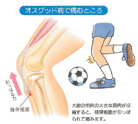 膝の成長痛 オスグット への対処 にすなっこの お役立ちページ 膝の成長痛 オスグット への対処 にすなっこの お役立ちページ