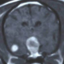 metastatic tumor（転移性腫瘍）_c0032335_19504532.jpg