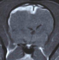 Granular Cell Tumor 顆粒細胞腫 獣医神経疾患画像集