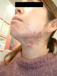 顔面プラセンタ注射 顔プラセンタ注射 によるニキビ治療 信州会クリニック 03 3662 1166