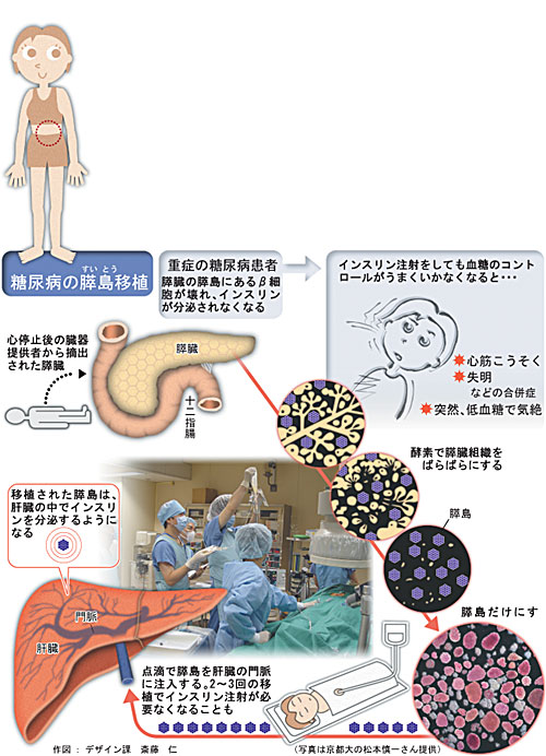 糖尿病の膵島移植 落書 ネタ帳2 糖尿病の膵島移植 落書 ネタ帳2