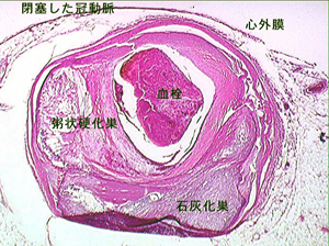 冠動脈の動脈硬化について_a0055913_2702.jpg