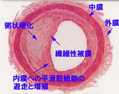 冠動脈の動脈硬化について_a0055913_29196.jpg