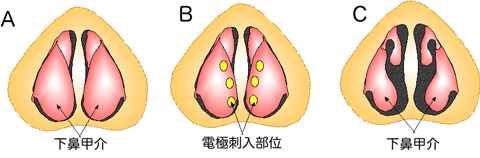 下鼻甲介焼灼術とは？_e0084756_14452218.gif