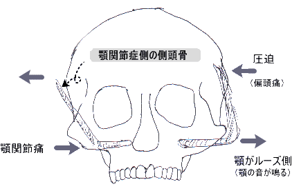 顎がガクガク関節症 Y嬢の おいしゅうございました 日記 顎がガクガク関節症 Y嬢の おいしゅうございました 日記