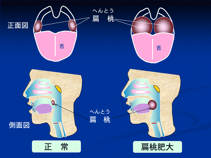 扁桃肥大_e0084756_1451682.gif