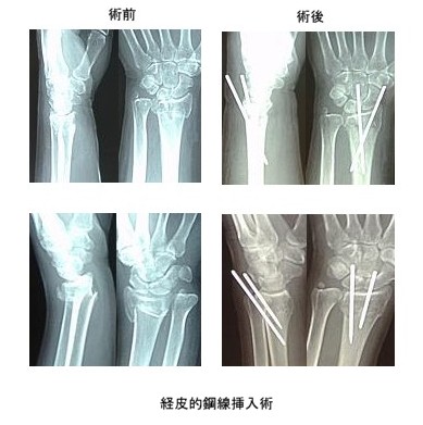 橈骨遠位端骨折 コーレス骨折 Colles fracture 心療整形外科