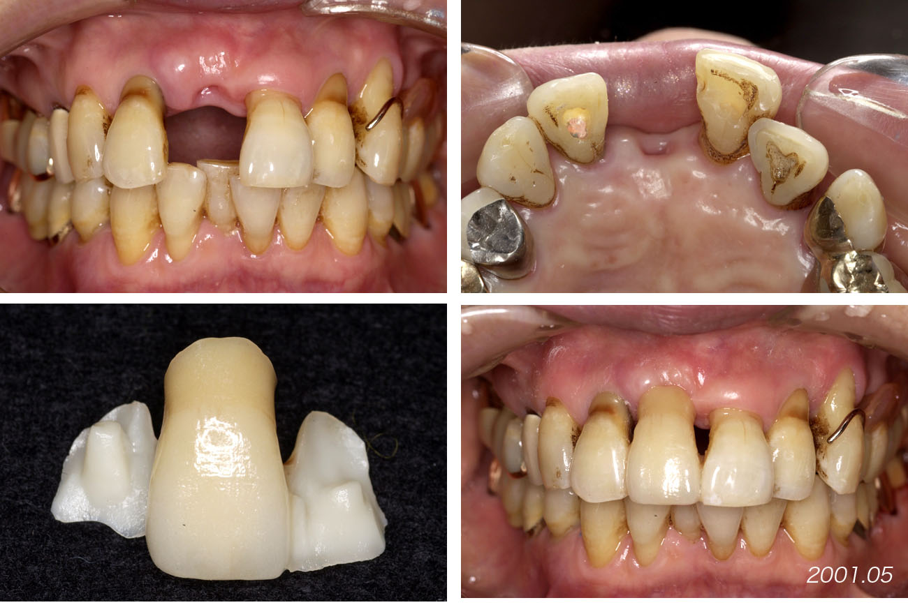 上顎の前歯部ブリッジ 2  　      Case 9_f0103459_1117560.jpg