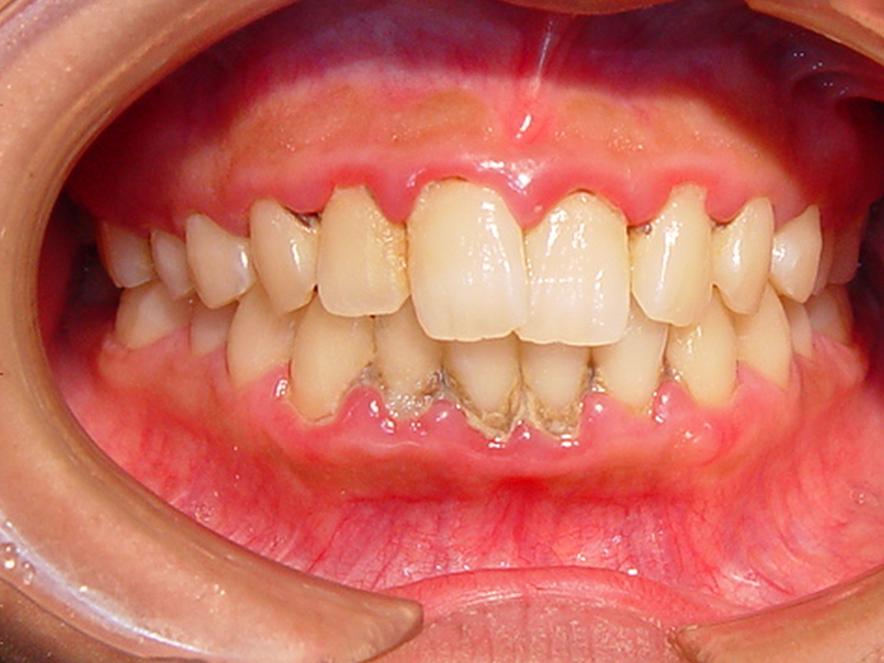 歯周病についてのお話 vol.１_f0048208_17451058.jpg