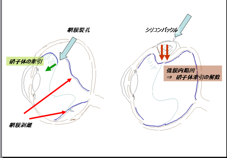 網膜剥離治療１_f0088231_8122831.jpg