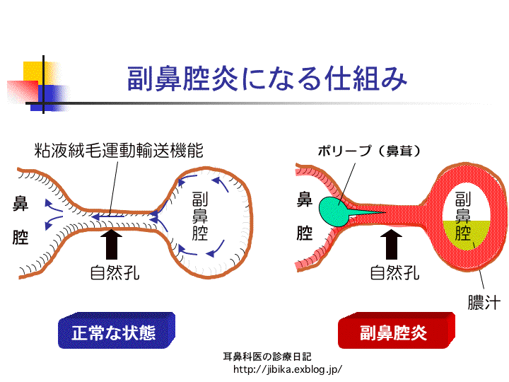 急性副鼻腔炎（その２）　〜診療シミュレーション〜_e0084756_11592459.gif