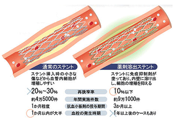 薬剤溶出ステントをめぐる諸問題_a0055913_856377.gif