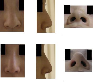 鼻尖縮小手術、Ｉ型鼻プロテーゼ、鼻尖部軟骨移植_d0092965_1544774.jpg