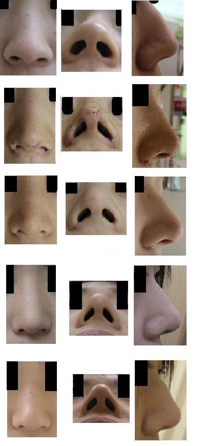 鼻尖縮小（びせんしゅくしょう）、小鼻縮小（こばなしゅくしょう）_d0092965_2203938.jpg