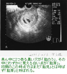 ツインズ誕生 回想記 妊娠2ヶ月 3ヶ月 涼ツインズママの苦悩