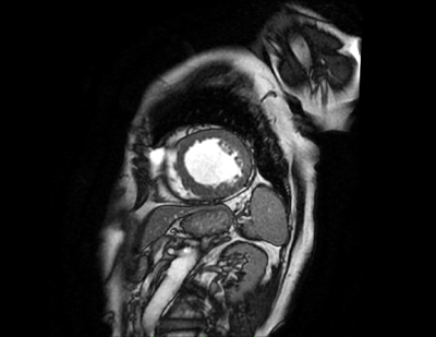 新しいMRによる心臓の評価_a0055913_039756.gif